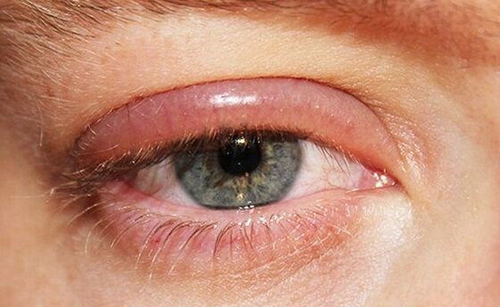 Eyelids are always inflamed